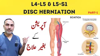 L4  L5 and L5 S1 Disc Herniation Treatment  Slip Disc Treatment At Home sciatica [upl. by Yv]