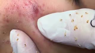 remove the blackheads white pimple remove black pimple remove how to remove blackheads on faces [upl. by Aiseneg]