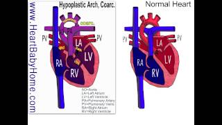 50 Hypoplastic Arch Coarc bicuspid [upl. by Bakeman]