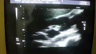 OBSTRUCTIVE UROPATHY due to UVJ calculus with UB DIVERTICULUM and an OVARIAN CYST [upl. by Ahcurb163]