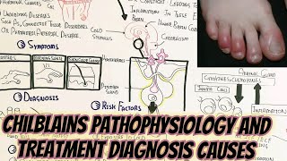 ChilblainsperniosisPathophysiologyTreatment SignSymptomDiagnosis [upl. by Lajib227]