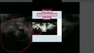 odontoameloblastomaoral pathologyameloblastic odontomaodontogenic tumor [upl. by Adela661]