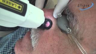 Tratamiento telangiectasias faciales con Ellipse NdYAG [upl. by Shornick]