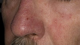 How to Treat Eczema on Face  Seborrheic Dermatitis Treatment  Face Eczema Treatment [upl. by Aititel203]