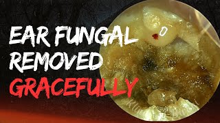 Ear Fungal Removed Gracefully [upl. by Aissak]