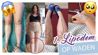 Meine 1 LIPÖDEM OPERATION  WADEN  Liposuktion Ergebnis Heilung Kosten etc  YooNessa [upl. by Monie275]