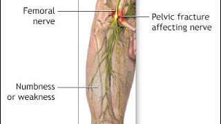 Femoral nerve effects of injury part9 دخالد البكوش [upl. by Devondra]