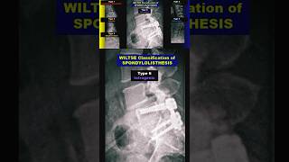 Spondylolisthesis  Wiltse Classification radiology bones spine xray [upl. by Atiuqan]