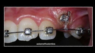 Exposure of unerupted canine using diathermy and orthodontic traction by Dr Amr Asker [upl. by Hgielra610]