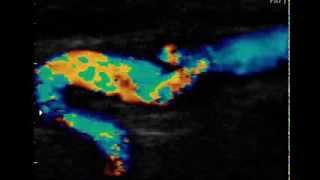 INTERNAL CAROTID ARTERY DISSECTION [upl. by Arahahs]