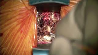 Cervical Disc Replacement with MobiC for Treatment of Cervical Disc Herniation [upl. by Ednarb435]