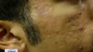 Gold Skin Care and Sublative treatment for Acne Patients [upl. by Judah]