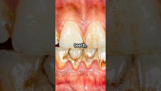 Gingivitis vs periodontistiswhats the difference [upl. by Jehial]