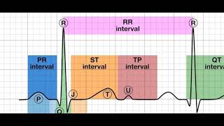 myocardial infarction stemi and nstemi [upl. by Pillihpnhoj]