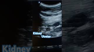 Kidney ultrasound Mild hydronephrosis due to ureteric calculus ultrasound doctor trending yt [upl. by Charlean]