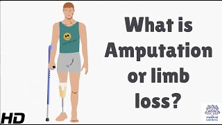 What is Amputation or Limb Loss [upl. by Tnahsin]