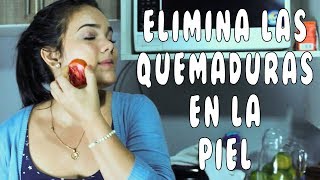 Alivia las quemaduras en la piel e insolación con el tomate [upl. by Philana]