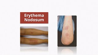 Erythema Nodosum  Causes amp Treatment [upl. by Saberhagen726]