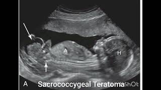 Ultrasound of Sacrococcygeal Teratoma Review from the book Requisites of Ultrasound [upl. by Yllas116]