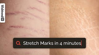 How Stretch Marks Happen [upl. by Lauer]