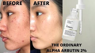 THE ORDINARY ALPHA ARBUTIN 2  HA REVIEW  BEFORE amp AFTER 6 WEEKS [upl. by Seabury]