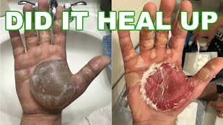 Second 2nd Degree Burn Treatment At Home How To Treat A Burn Blister At Home [upl. by Aldwin]