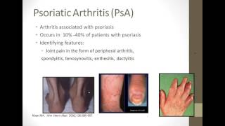 Living Well with Psoriatic Arthritis What You Need to Know [upl. by Nonnahs]