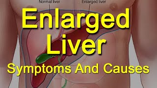 Enlarged Liver Symptoms And Causes  What Is Hepatomegaly [upl. by Fosdick]