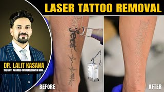 LASER TATTOO REMOVAL  BEFORE amp AFTER [upl. by Graybill]