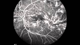 Proliferative Diabetic Retinopathy [upl. by Genet]