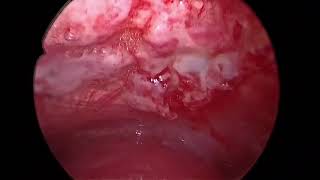 Rigid Thoracoscopy  Pleural Biopsy  Talc Poudrage  Malignant Pleural effusion [upl. by Hoenack]