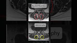 How to check Multifidus muscle in MRI [upl. by Aronoel]