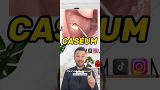 Qu’est ce que le Caséum  tonsil tonsilstones tonsilitis caseum breath breathing santé [upl. by Gnouhc]