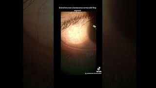 Scleral contact lens over a keratoconus cornea Keratoconus Sclerallens Cornealring CXL Intac [upl. by Analiese480]