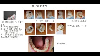 乳牙龋齿自然修复6年跟踪研究 [upl. by Notniuq]