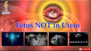 Fetus NOT in Utero [upl. by Rosario122]