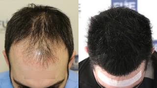 FUE Hair Transplant 3467  1000 grafts in NW  Class IV  A Dr Juan Couto  FUEXPERT CLINIC [upl. by Vogeley]