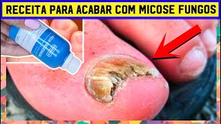 Elimine os fungos nas unhas com 5 tratamentos caseiros naturais [upl. by Earesed]