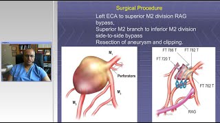 Management of Complex Aneurysms Clip Reconstructions and Bypass Techniques Preview [upl. by Jasik]