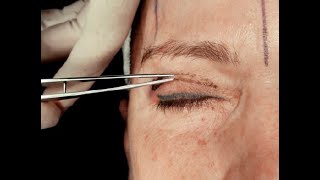 Peeling Eczema from Eyelid [upl. by Nareik]