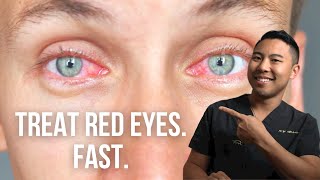 How to get rid of red eyes FAST  Ophthalmologist MichaelRChuaMD [upl. by Rumery]