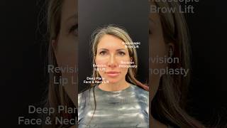 Facelift before and after browlift revisionrhinoplasty revisionfacelift liplift nycfacelift [upl. by Bluma]