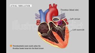 Thromboembolic event in heart with atrial fibrillation [upl. by Eenttirb948]