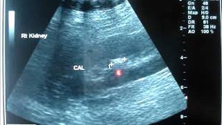 Ultrasound for KIDNEY STONE [upl. by Jo492]