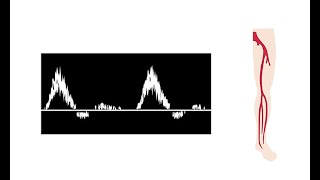 Interpreting duplex waveforms [upl. by Emie]