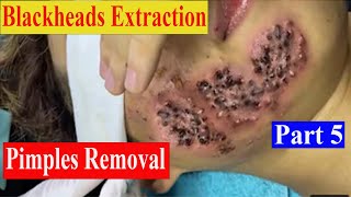 big cystic acne blackheads extraction blackheads amp milia whiteheads acny removal pimple popping [upl. by Aifos]