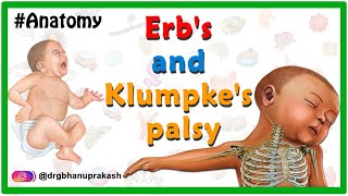 Erbs palsy and klumpkes palsy USMLE Animation  Etiology Clinical features Diagnosis Treatment [upl. by Lazarus]