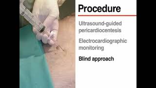 Pericardiocentesis by NEJM [upl. by Nolrac]