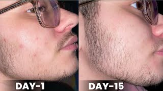 Day1 to day15 minoxidil beard growth results  minoxidil beard growth  derma roller for beard [upl. by Eelah]