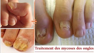 Traite les mycoses des ongles et traite les peaux mortes sous longle [upl. by Sheree]